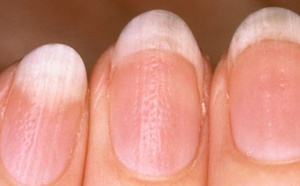 Ce que vos ongles révèlent sur votre santé