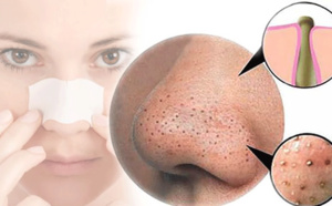 Voici le meilleur moyen de se débarrasser des points noirs