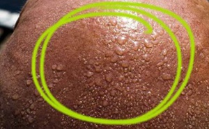 12 signes qui montrent que vous manquez de vitamine D