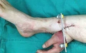 Ils lui ont implanté une main dans le pied pour la maintenir en vie… Cette histoire va vous donner des cauchemars