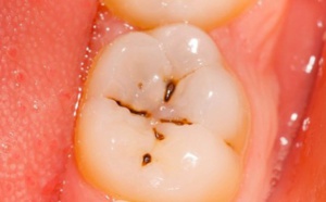 Voici comment ne plus avoir de caries