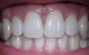 Voici comment ne plus avoir de caries ni de problèmes de gencives