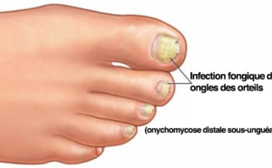 Voici comment guérir une mycose des ongles naturellement