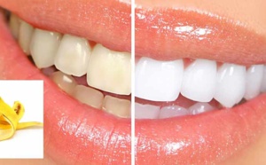 Comment blanchir mes dents avec une peau de banane