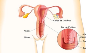 Voici comment prévenir le cancer du col de l’utérus ?