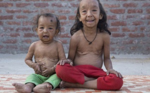 L'histoire de ces deux jeunes enfants Indiens ressemblant étrangement à « Benjamin Button » va vous bouleverser