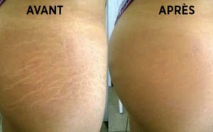 Voici comment se débarrasser naturellement des vergetures en 6 semaines !