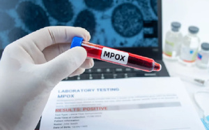 Cas de variole du singe détecté au Sénégal :  Le ministère confirme un cas de Mpox chez un étranger à Dakar