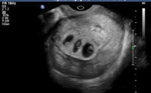 Naissance miraculeuse d'un bébé condamné à mourir dans l'utérus