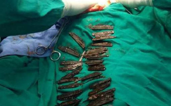 Les médecins lui retirent 40 couteaux de l'estomac