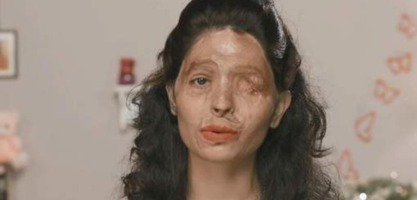 Défigurée à l'acide, elle va défiler à la Fashion Week