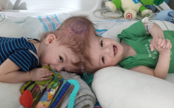 Insolite : deux bébés siamois à la tête séparés après 27 heures d'opération