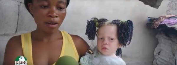 Insolite: Elle a été rejetée par son compagnon pour avoir mis au monde une petite fille albinos (vidéo)