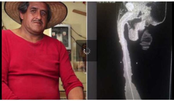 Avec une longueur de 48 centimètres, cet homme a le plus grand pénis du monde et vient d’être reconnu comme handicapé !