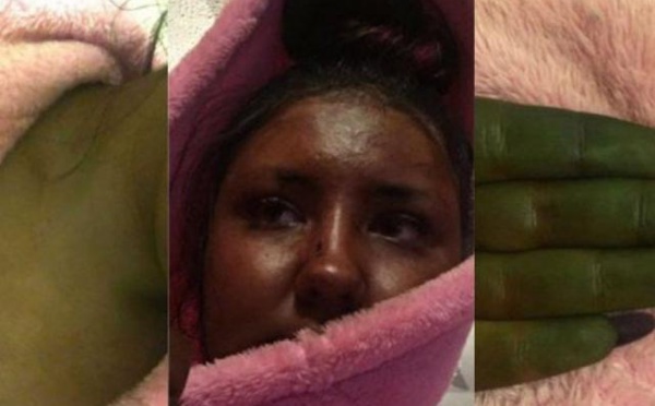 Sa peau vire au vert après avoir utilisé un autobronzant