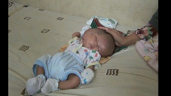Indonésie : Un bébé naît avec deux visages, deux cerveaux et une seule tête (vidéo)