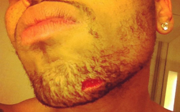 Photo : Chris Brown le menton en sang après une bagarre
