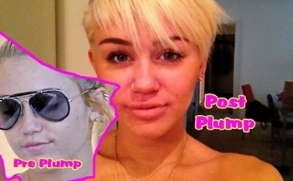 Miley Cyrus, des injections aux lèvres ?