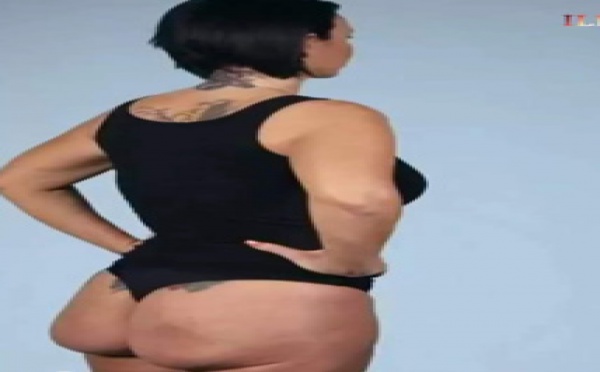 Elle voulait de jolies fesses : Voilà le résultat quatre ans après l'opération