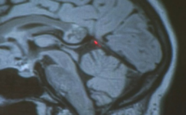 Etats-Unis: Elle vivait avec "son jumeau embryonnaire" dans son cerveau depuis vingt-six ans
