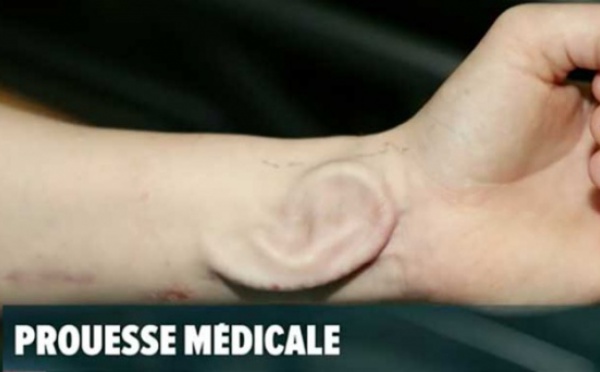 Une oreille pousse sur son avant-bras