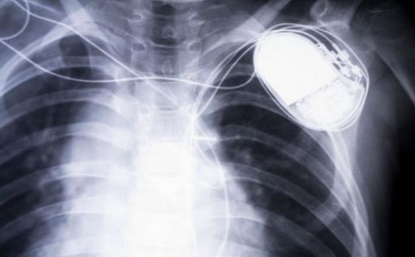 Opérée du cœur, elle vit avec les 14% de batterie restante de son stimulateur