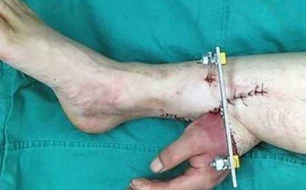 Ils lui ont implanté une main dans le pied pour la maintenir en vie… Cette histoire va vous donner des cauchemars