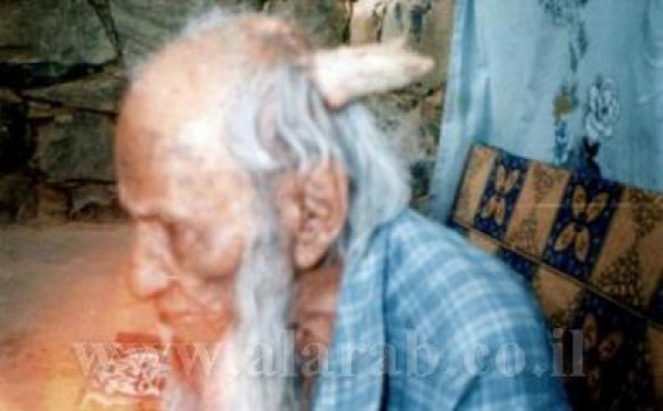 L'homme de 160 ans avec une corne à la tête