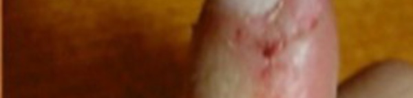 Si vous rongez la peau autour de vos ongles, il faut arrêter. Voici pourquoi.