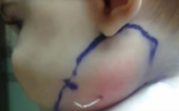 Choc : des médecins retirent une plume de la gorge de ce bébé !