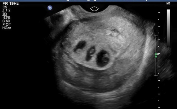 Naissance miraculeuse d'un bébé condamné à mourir dans l'utérus