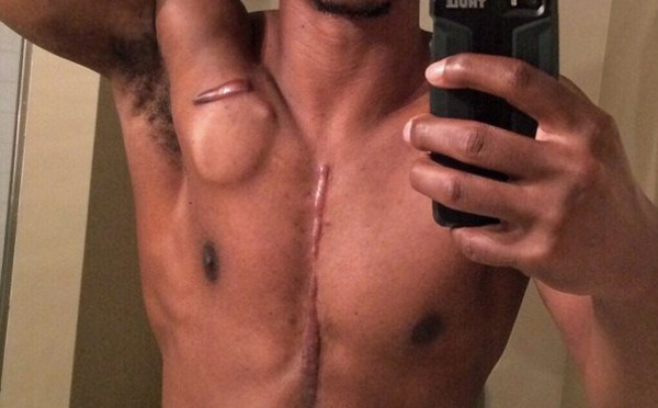 Vidéo : L’histoire émouvante d’un bodybuilder de 26 ans qui porte son cœur dans un sac à dos