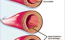 MALADIES DU MAL DEVELOPPEMENT, DE L’IGNORANCE... Les affections cardio-vasculaires : ces tueurs en série source de handicaps