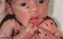 Un bébé avec une maladie de peau se fait poser des implants