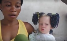 Insolite: Elle a été rejetée par son compagnon pour avoir mis au monde une petite fille albinos (vidéo)