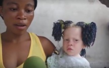 Insolite: Elle a été rejetée par son compagnon pour avoir mis au monde une petite fille albinos (vidéo)