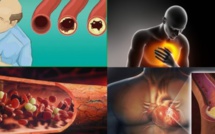 Santé: attention! Voici ce qui bouche les artères et cause la mort