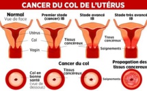 Cancer du col de l’utérus : « Chaque année, le Sénégal enregistre 875 cas », selon la Lisca