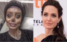 Vidéo-Elle fait plus de 50 opérations pour ressembler à Angelina Jolie