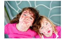 77 cas de rougeole à Bordeaux... Une épidémie inadmissible !