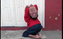 Brésil: Grâce à sa mère, cet homme né la tête à l’envers, est un modèle (Vidéo)