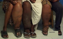 Côte d’Ivoire: 74 districts sanitaires touchés par la maladie de l'éléphantiasis!