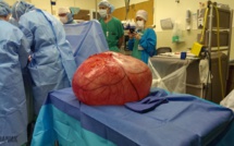Insolite : Une tumeur ovarienne de 60 kilos retirée d'une femme