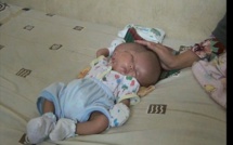 Indonésie : Un bébé naît avec deux visages, deux cerveaux et une seule tête (vidéo)