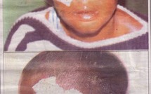 ELLE NE SUPPORTE PAS QUE SON EX-MARI EPOUSE SA VOISINE : Absa arrache l'oeil de sa rivale avec de l'acide et la fait avorter