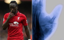 Liverpool – Blessure au pouce : 3 mois d’arrêt pour Sadio Mané ?
