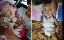 Insolite : Un bébé développe des « cornes » après une opération chirurgicale (Photos)
