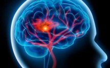 Prévention des AVC: 70% des cas peuvent être évités simplement