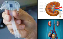 Adieu la machine de dialyse : les scientifiques ont créé un rein bionique !