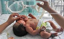 Un bébé chinois naît avec deux têtes